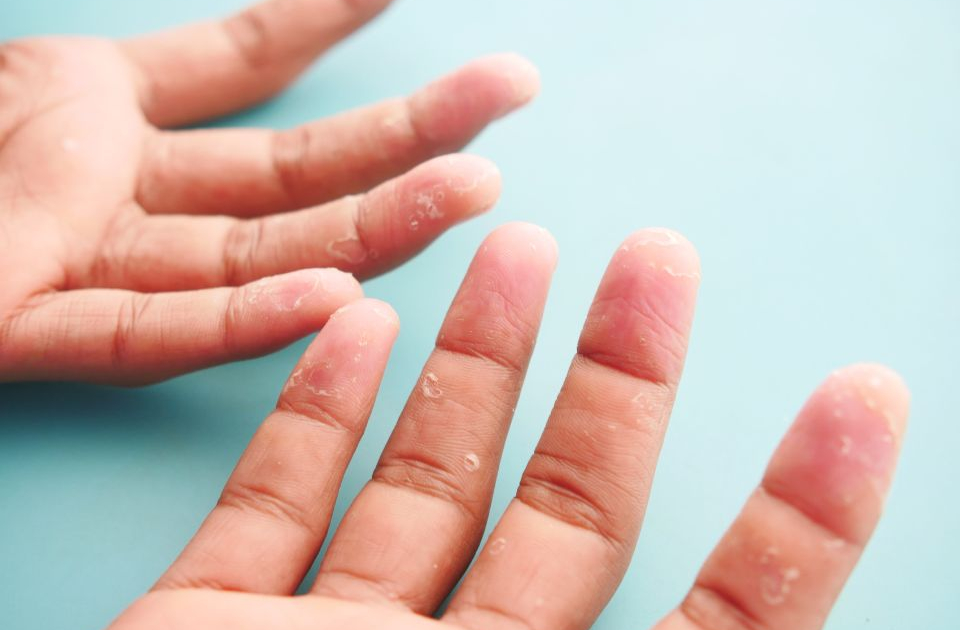 Autoimmune skin conditions could be treated by targeting T cells Doherty site