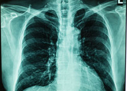 Improving the health of people with Tuberculosis in Victoria