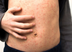 Measles cases are on the rise globally. Should we be concerned?