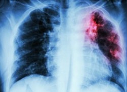 Tuberculosis – Still a Major Killer