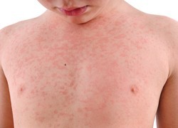 Emerging cases of measles in people who have been vaccinated